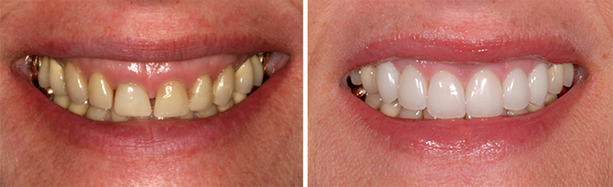 Before And After Periodontal Treatment Photos In Los Angeles