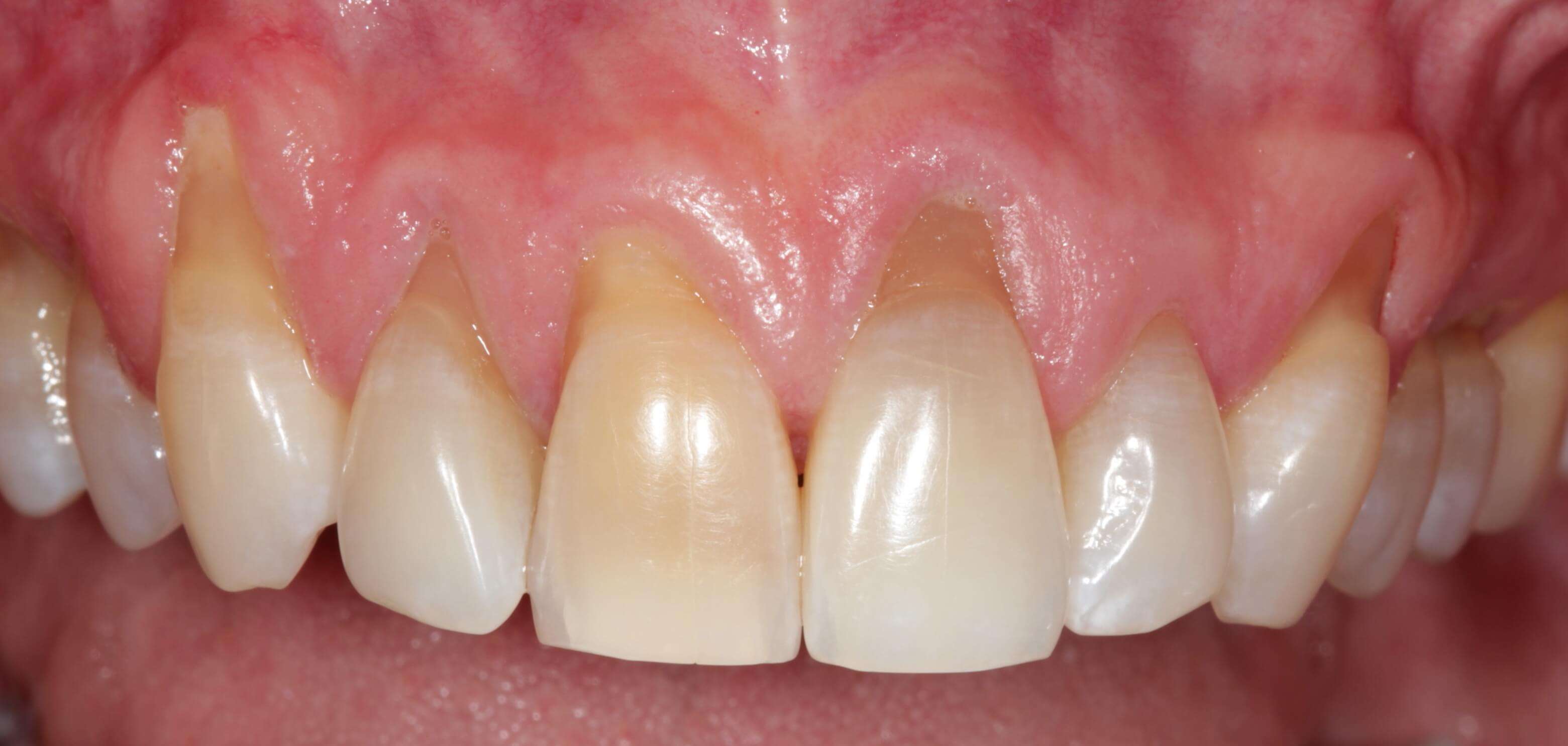 signs-that-your-gums-are-receding