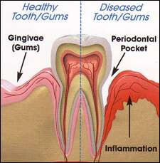 Is It Time to Undergo Periodontal Scaling or Root Planing?