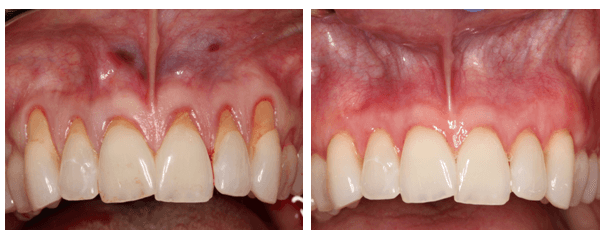 Bleeding Gums: Are You at Risk?