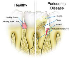 Why See a Periodontist for Gum Disease?