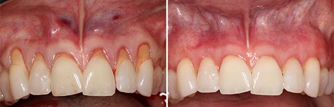 Gum Grafting Treatment and Periodontal Surgery by LA Experts