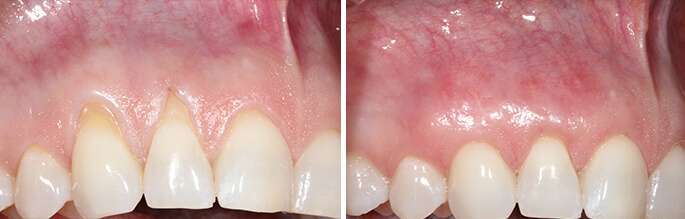 5 Early Signs Of Receding Gums Shared By Los Angeles Periodontists