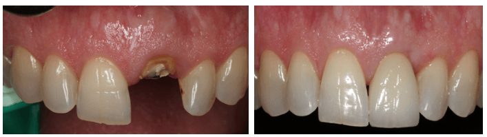 Dr. Alexandre Aalam Explains Why Your Periodontist Should Be Well Informed On Dental Implants