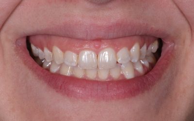 Is Excess Gum Tissue Giving You an Extra Gummy Smile?