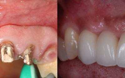 Are Dental Implants Noticeable?