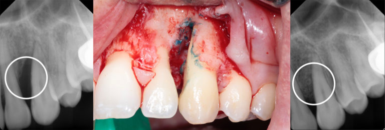 Periodontal Regeneration Implant Perio Center 