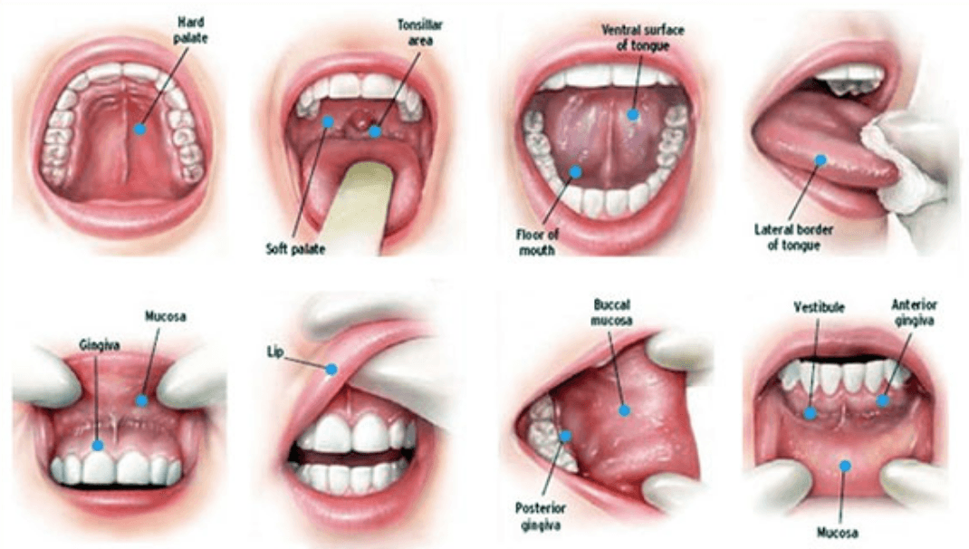 Oral Cancer Screening Exam Los Angeles La Periodontal Experts 