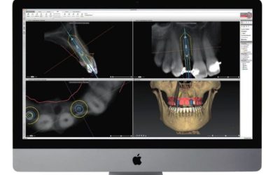 Romans Had Less Periodontal Disease than Modern Society