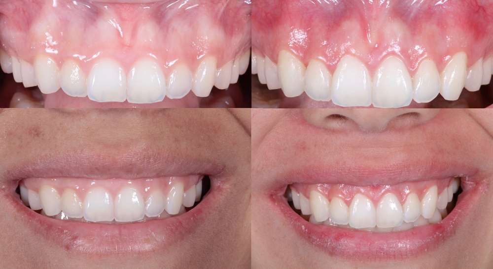 Aesthetic Crown Lengthening Los Angeles La Periodontists