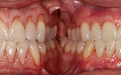 When is the Right Time for a Gum Graft?