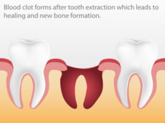 How to Prevent Dry Socket After Teeth Extraction