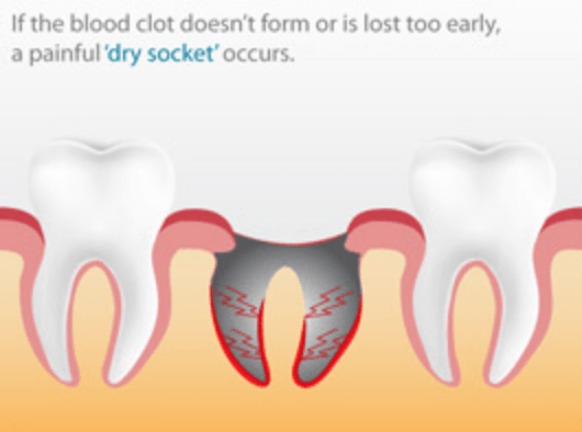 Dry Socket Tooth: Causes, Symptoms, Treatment & Prevention