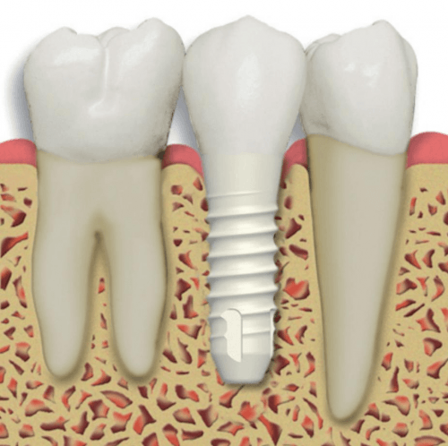Dental Implants in Los Angeles for Missing Teeth at Implant Center