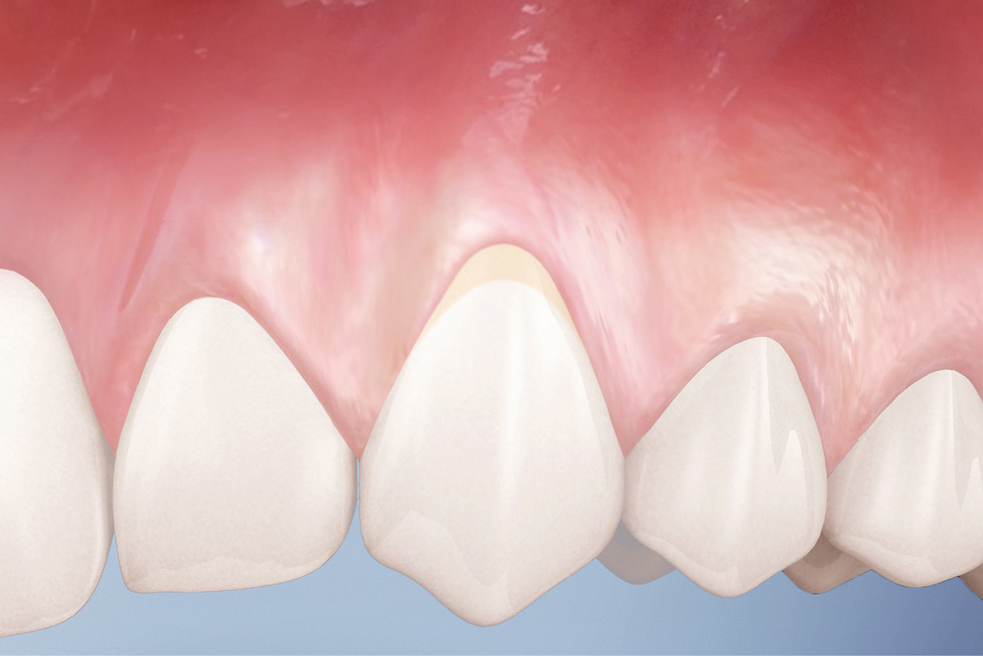 TOOTH ROOT EXPOSURE IMPLANT PERIO CENTER