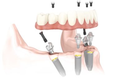 All-on-4® Teeth in a Day What You Need To Know