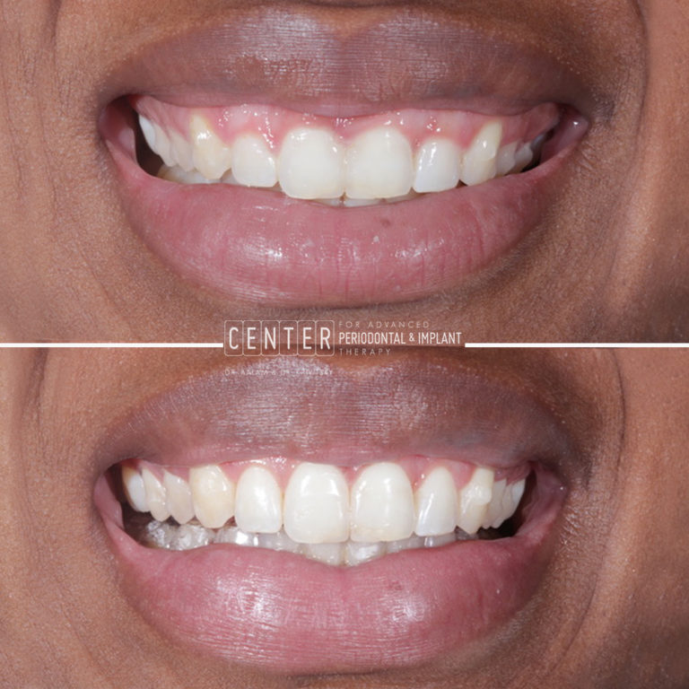 Aesthetic Crown Lengthening Los Angeles | LA Periodontists