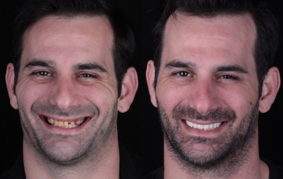 Before And After Periodontal Treatment Photos In Los Angeles