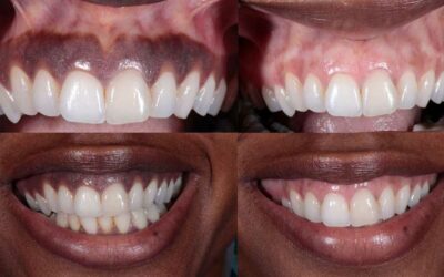 The Benefits of Gum Depigmentation