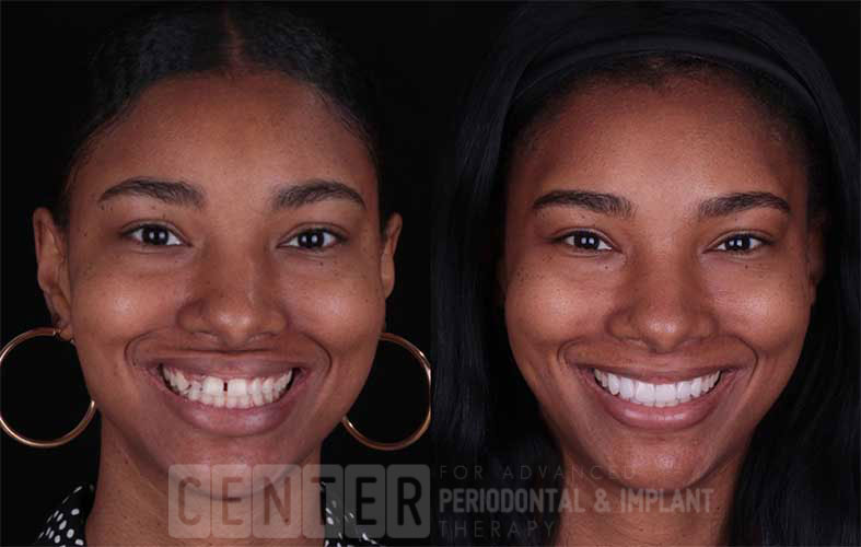 gingivitis before and after treatment