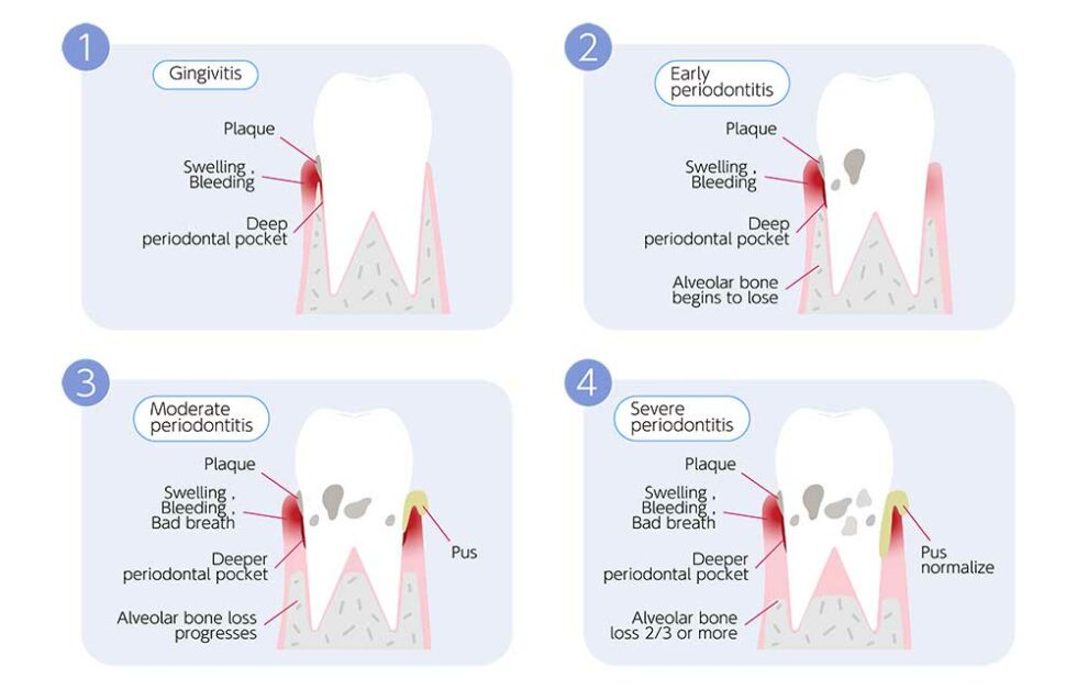 What Are The Stages Of Periodontal Disease? - IMPLANT PERIO CENTER