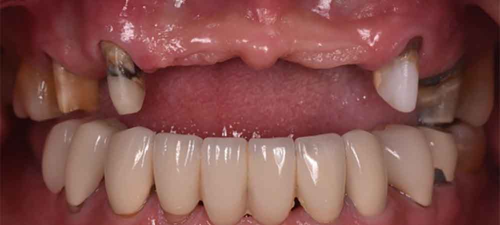 Replace Missing Front teeth with Tooth Colored filling, Implant or denture
