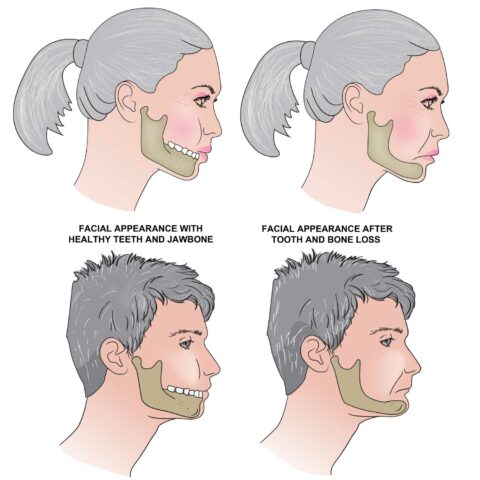 The Consequences of Tooth Loss On Your Jawline and Facial Appearance ...